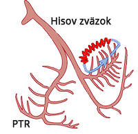 Fascicular ventricular tachycardia reentry, anterograde and retrograde conduction