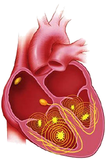 ventricular fibrillation