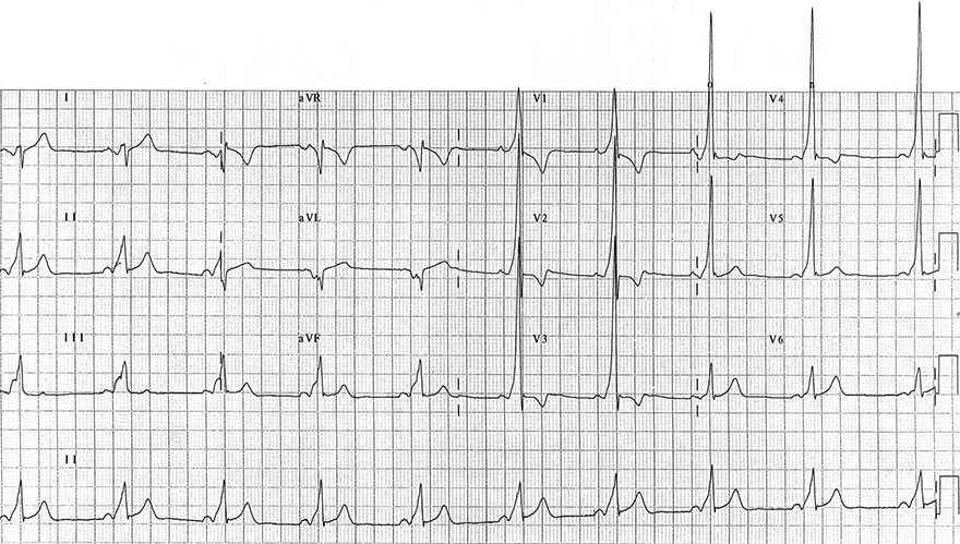 ECG wpw syndrome, Type A, Short PR interval, broad QRS, delta wave, pseudo-infarction pattern, left-sided accessory pathway