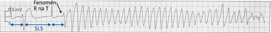 ECG short-long-short ventricular cycle, pause dependent QT prolongation, Torsades de Pointes (TdP)