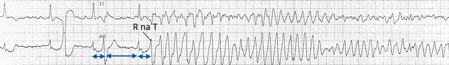 ECG Torsades de Pointes, prolonged QT interval, Phenomenon R on T, short-long-short sequence (SLS) 