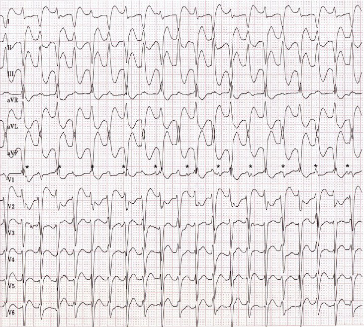 ECG Multifocal ectopy and bidirectional VT secondary to digoxin poisoning