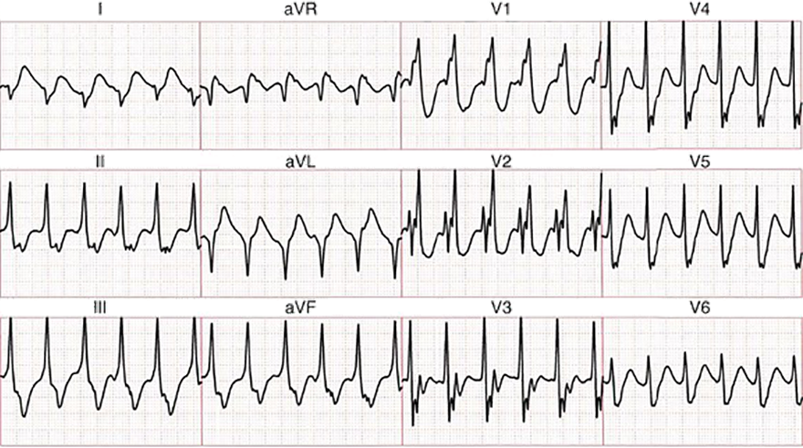 ECG interfascicular reentry VT, narrow QRS complex ventricular tachycardia