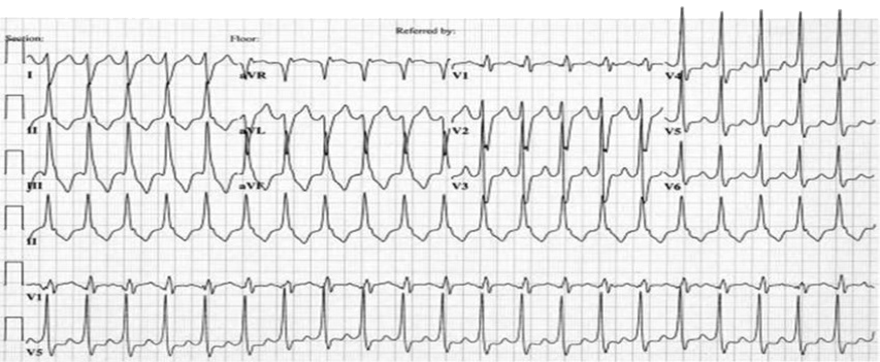 ECG Idiopathic  Left Ventricular Outflow Tract (LVOT) Tachycardia