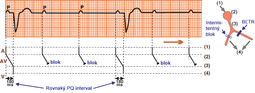 Laddergram (A, AV, V), second degree 2nd AV block, Mobitz II