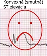 Convex (non-concave) ST segment elevation, acute STEMI infarction