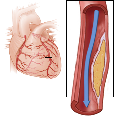 unstable angina pectoris, proximal left anterior descending artery stenosis