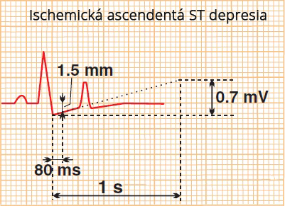 Slow ischemic upsloping ST segment depression, No ST segment elevation acute coronary syndrome, unstable angina, NSTEMI