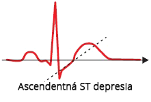 ECG upsloping ST segment depression, No ST segment elevation acute coronary syndrome, unstable angina, NSTEMI