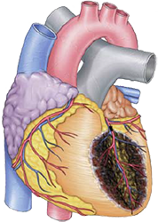 subacuta anterior STEMI infarction, anterior wall STEMI, LAD occlusion - culprit vessel - artery