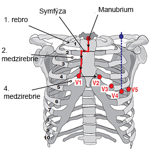 Correct position of the precordial electrodes, diagnosis anteroseptal myocardial infarction, left anterior hemiblock (LAF)