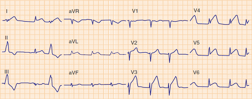 ECG acute anterior STEMI infarction, occlusion distal LAD, ST elevation V3-V6