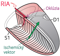 Left anterior descending artery (LAD) occlusion proximal DI, and distal S1