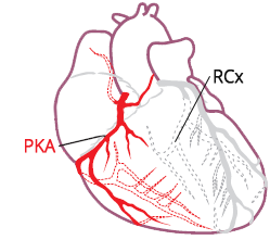Right coronary artery, left circumflex artery, culprit vessel, ECG V4R lead