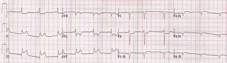ECG acute inferior (ST elevation II, III, aVF) and right ventricular STEMI (ST elevation V3R-V6R) infarction
