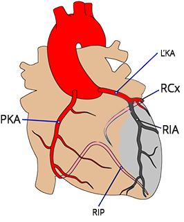 proximal LAD occlusion - culprit artery
