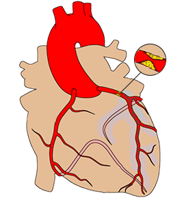 aVR ST elevation, Left main coronary artery (LMCA) insufficiency (stenosis)