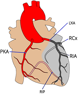 ST elevation in aVR, Left main coronary artery (LMCA) occlusion