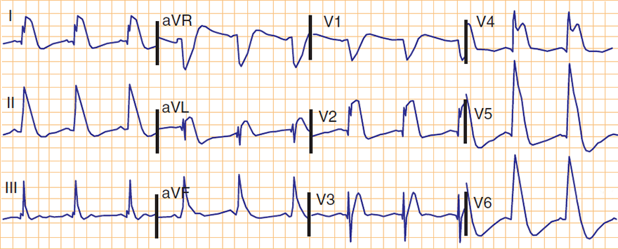 ECG ST elevation (aVR) occlusion left main stem, massive ST elevation - Pardee curve - wave