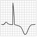 ECG pericarditis stage 3, flattened T waves, inverted T waves