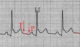 ECG pericarditis spodick sign, TP segment depression