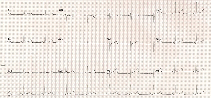ECG benign early repolarisation, sinus bradycardia J wave