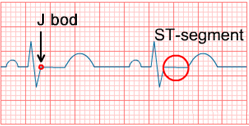 ECG J point, ST elevatin, ST segment