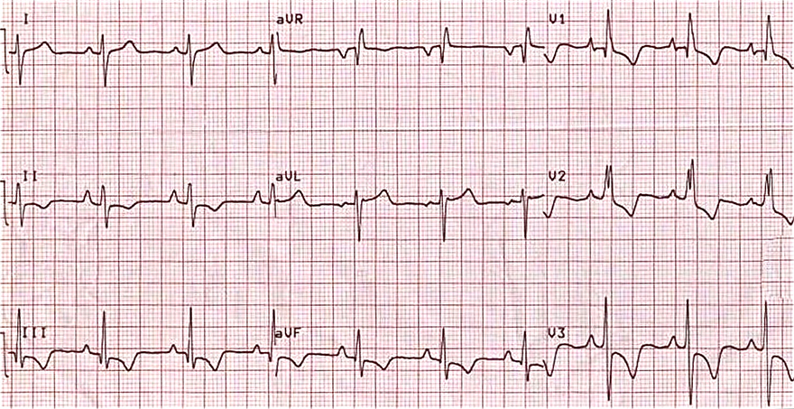 ECG right vetricular hypertrophy, incomplete right bundle branch block (RBBB), Right ventricular strain pattern, Right axis deviation, 
