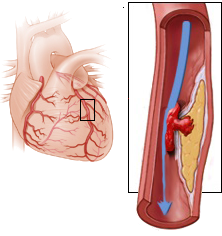 critical stenosis of the left anterior descending artery (LAD) RIA
