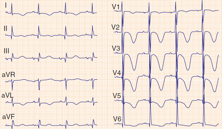 ECG subarachnoid haemorrhage, giant cerebral T wave invarsion, prolonged QT interval