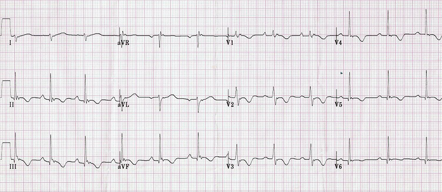 ECG arrhythmogenic right ventricular dyplasia and Counterclockwise (CCW) rotation, Early transition zone