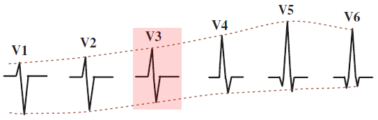 ECG precordial leads, normal R wave progression and transition zone