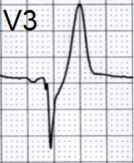ECG criteria, De Winters T waves (V1-V6)