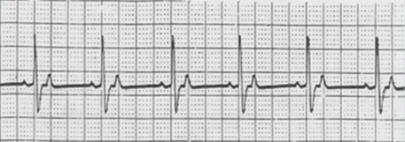 ECG pacemaker DDD tracking mode AsVs (atrial sensing, ventricular pacing)