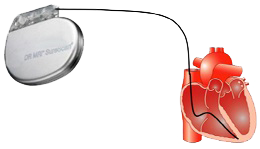 Heart ventricular pacing