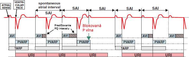 ECG DDD (AsVp) pacemaker wenckebach, AVI, PVARP, TARP, URI, SAI (spontaneous atrial interval)