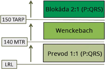 Pacemaker upper rate response, LRL, 1:1 conduction, MTR, Wenckebach, TARP, 2:1 block
