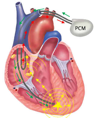 Dual chamber pacemaker, Pacemaker mediated tachycardia (PMT), Endless loop tachycardia (ELT), Pacemaker Circus movement tachycardia (PcmT)