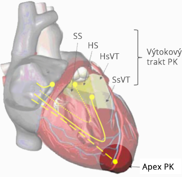 Heart right ventricular apical pacing