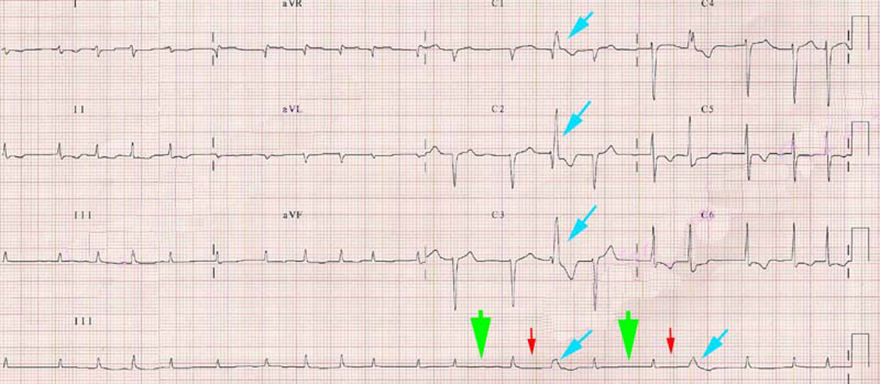 ECG atrial fibrillation, Phase 3 long-short cycle sequence aberrancy, aberrant ventricular conduction, RBBB morphology