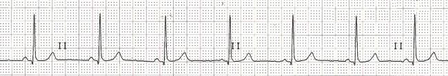 Overdrive suppression, primary SA node pacemaker, suppressed AV junctional automaticity