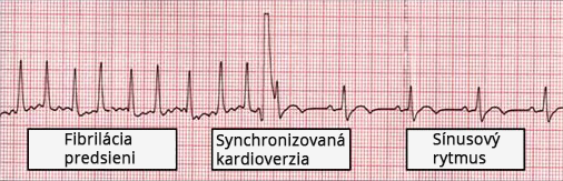 ECG atrial fibrillation, synchronized cardioversion with QRS