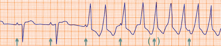 ECG incomplete av dissociation, ventricular tachycardia