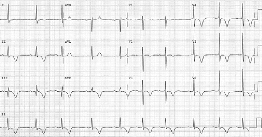 ECG cardiac memory,  Memory induced T wave, Electrical remodeling, Chatterjee phenomenon (Post pacing T wave inversion)