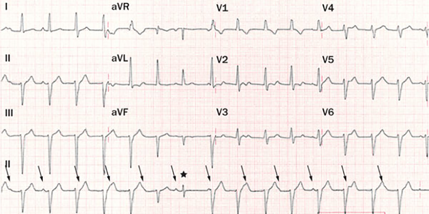 ECG Brugada algorithm, AV dissociation, Fusion beat, Capture beat, Narrow complex fasciculer ventricular tachycardia