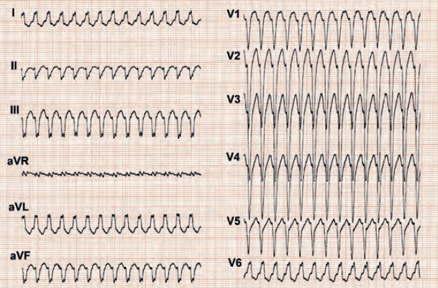 ECG wide complex tachycardia, Brugada algorithm, LBBB morphology, left axis deviation, SVT with LBBB tachycardia