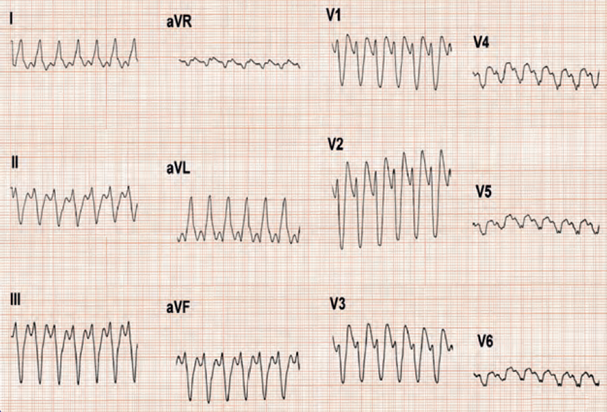 ECG ventricular tachycardia RBBB morphology, Brugada algorithm No RS copmlex in precordial lead 