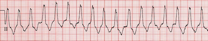 aVR algorithm - Andras Vereckei, Differential Diagnosis (DDx) of Wide-Complex Tachycardia, ventricular tachycardia