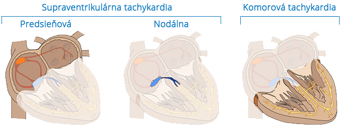 Supraventricular (Atrial, Nodal) tachycardia, Ventricular tachycardia