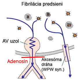Adenosine AV node block, Atrial fibrillation, accessory pathway, ventricular fibrillation